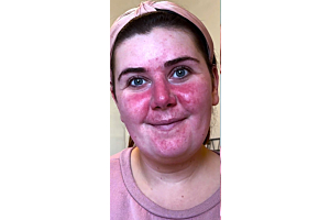 Young mum with rosacea misses out on family photos until she discovers best cream for rosacea 