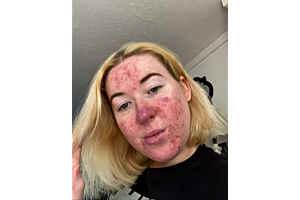 Young woman who developed rosacea as a teenager finds magical concealer that cleared her skin