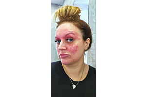 Mum with adult acne mistakenly prescribed steriods that made her skin livid finds 'miracle' solution in a serum made with silver