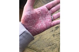 New mum who couldn't change her baby's nappy due to her painful hands finds best solution for hand psoriasis without steroids