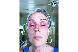 Best eye cream for eye eczema clears mum's agonising perimenopausal eye eczema in days