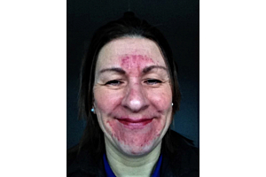 Bullied police officer's stressed-triggered skin was transformed with best rosacea cream