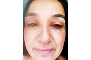 Women with ‘toad eyes’ from menopausal eye eczema discovered best eye cream that cleared it in days 