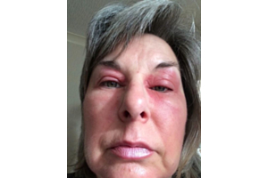 Beer triggers woman’s menopausal blepharitis but a vine eye gel ended suffering when nothing else worked