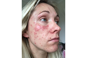 Could weight loss jabs also work for improving psoriasis?