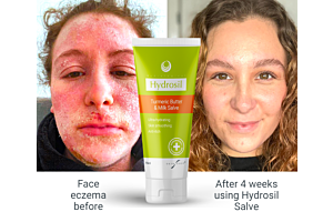 Young mum with TSWS finds best natural cream for eczema containing plant-steroid and donkey milk clears skin in weeks