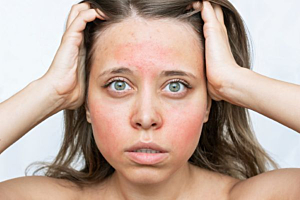Could your acne actually be rosacea?
