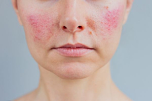 New study finds antidepressants effective for treating rosacea