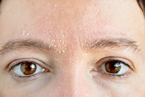 Is skin microdosing the key to managing eczema?