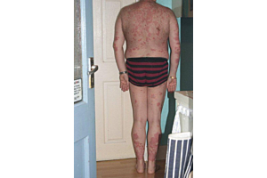 Women refused to even meet chef with 80% psoriasis until a plant root cream rescued his skin and now he's getting married