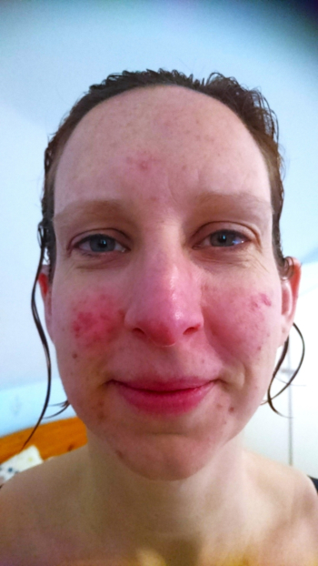 NHS worker's rosacea triggered by cooking Christmas dinner finds best rosacea cream which clears her skin in weeks