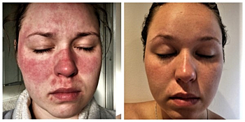 Mum-to-be with rosacea couldn’t look in the mirror until Kalme rescued her ravaged red skin