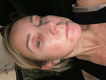  Mum with perimenopausal eye eczema hid at home until best cream for eye eczema helped her return to fashion career