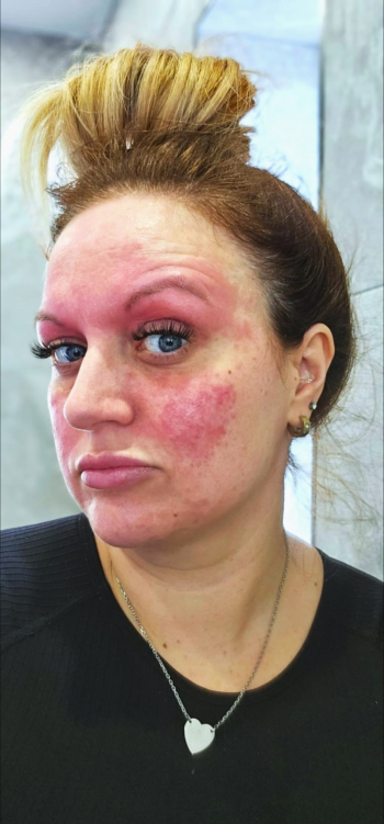 Mum with adult acne mistakenly prescribed steriods that made her skin livid finds 'miracle' solution in a serum made with silver