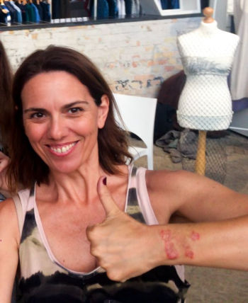Mum hails donkey milk salve as best cream for hand eczema bought on by traumatic divorce 