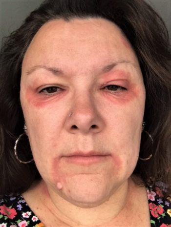 Is menopausal blepharitis common? 4 women share their experiences & relief at finding best cream for menopausal eye eczema
