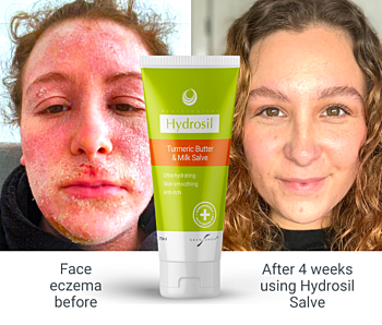 Young mum with TSWS finds best natural cream for eczema containing plant-steroid and donkey milk clears skin in weeks