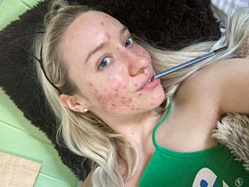 Abusive relationship triggered marketing consultant's cystic acne